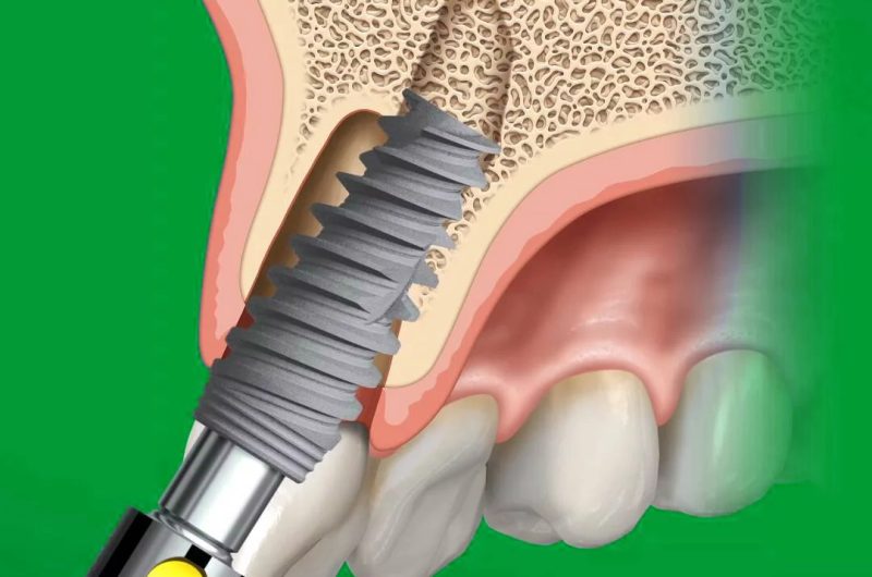 nobelactive implant