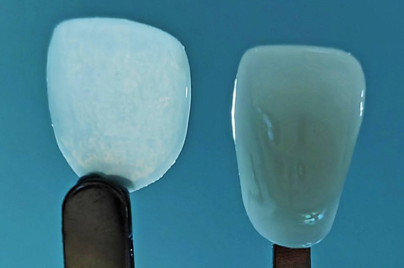 Thinnest Cosmetic Dental Veneer