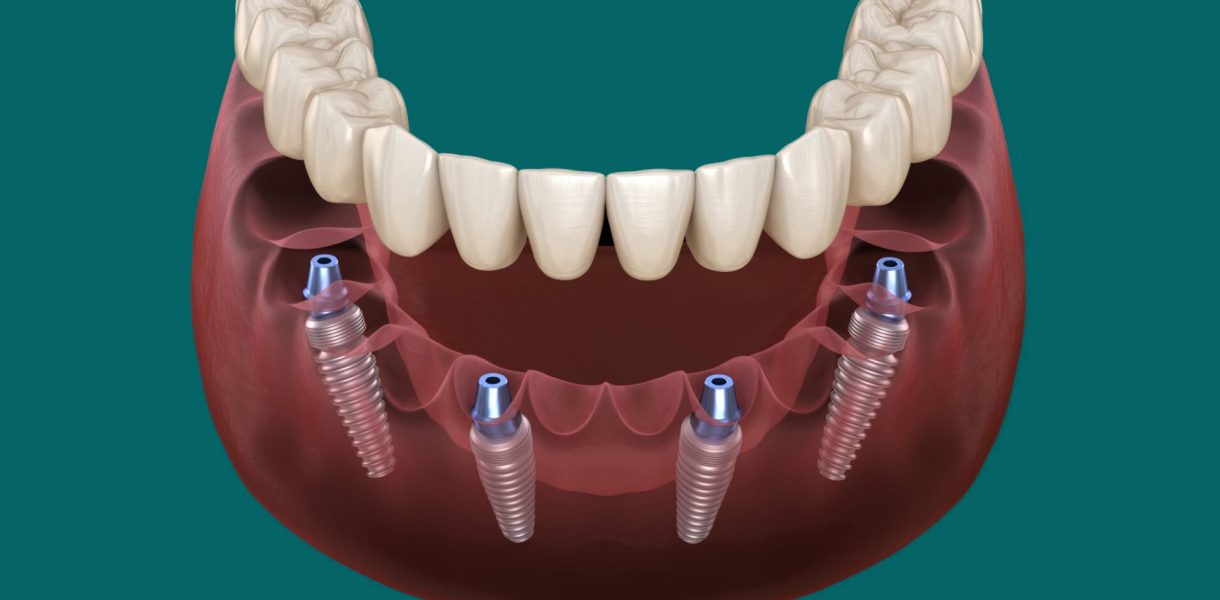 all on 4 dental implants