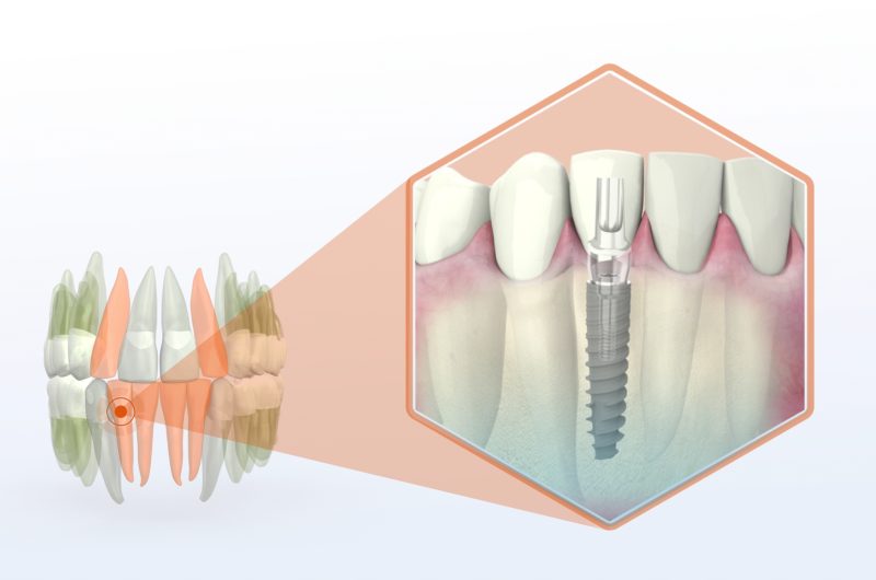 mini dental implants