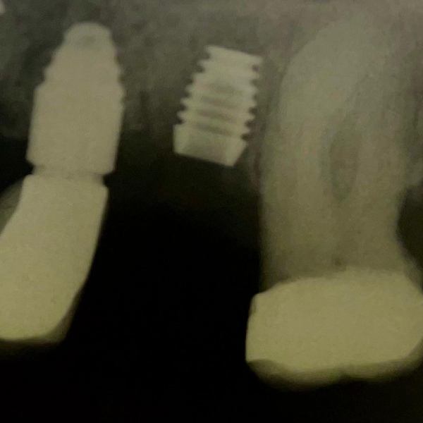 Bicon Short implants Compatible